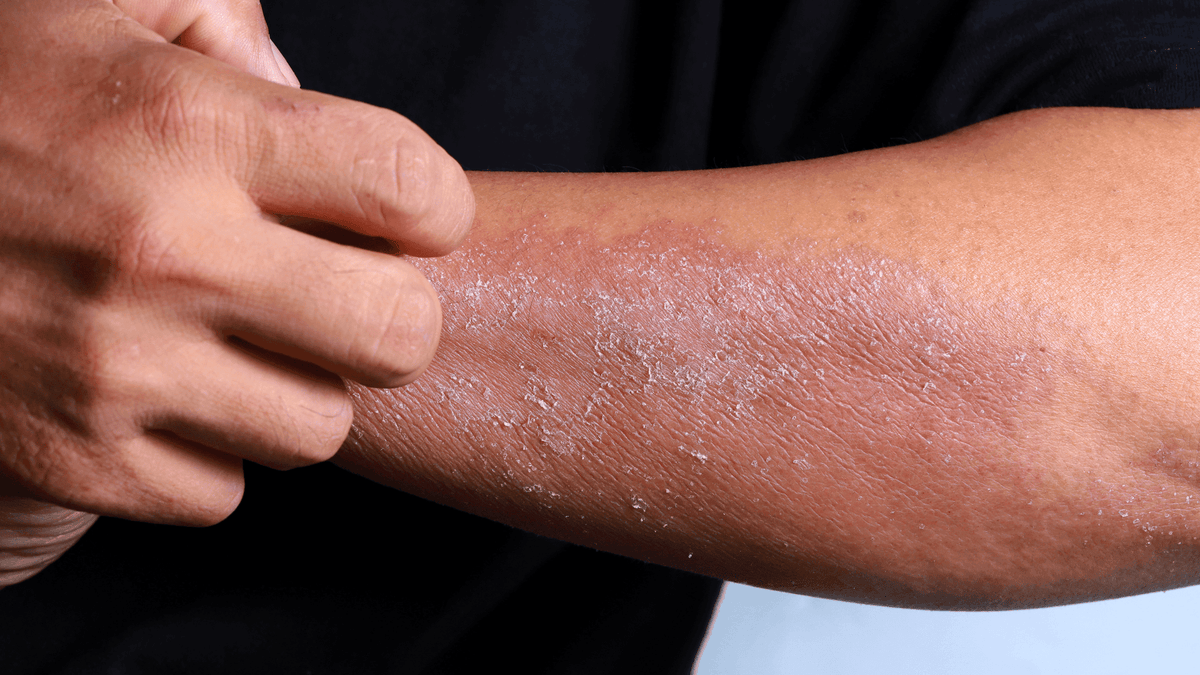 Eczema Explained: Causes, Symptoms, and How to Treat It - GRAES