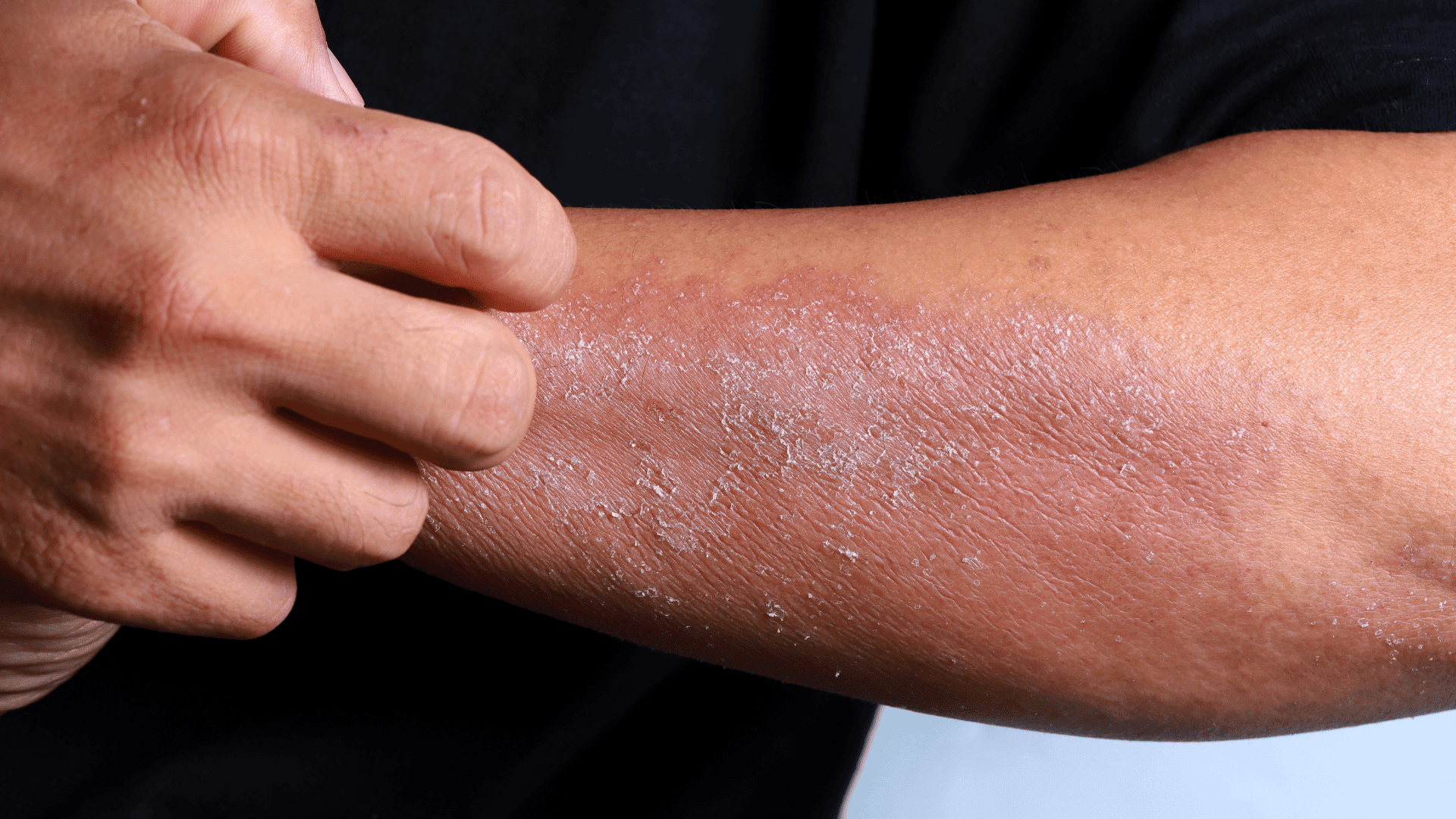 Eczema Explained: Causes, Symptoms, and How to Treat It - GRAES