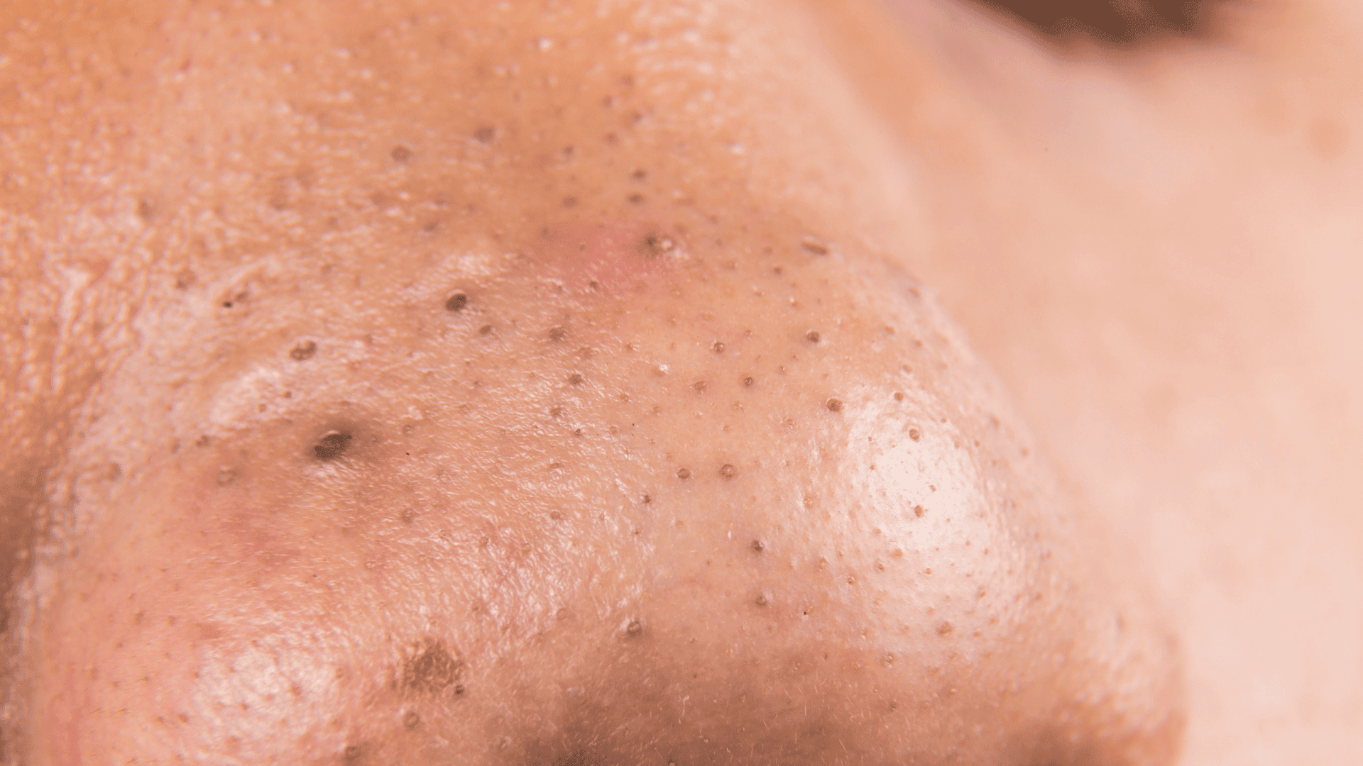 How to Remove Blackheads Without Damaging Your Skin - GRAES