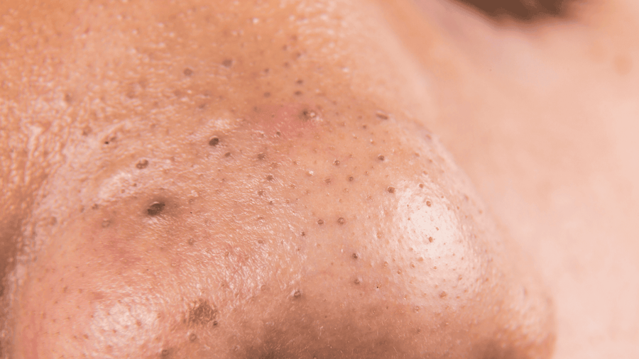 How to Remove Blackheads Without Damaging Your Skin - GRAES