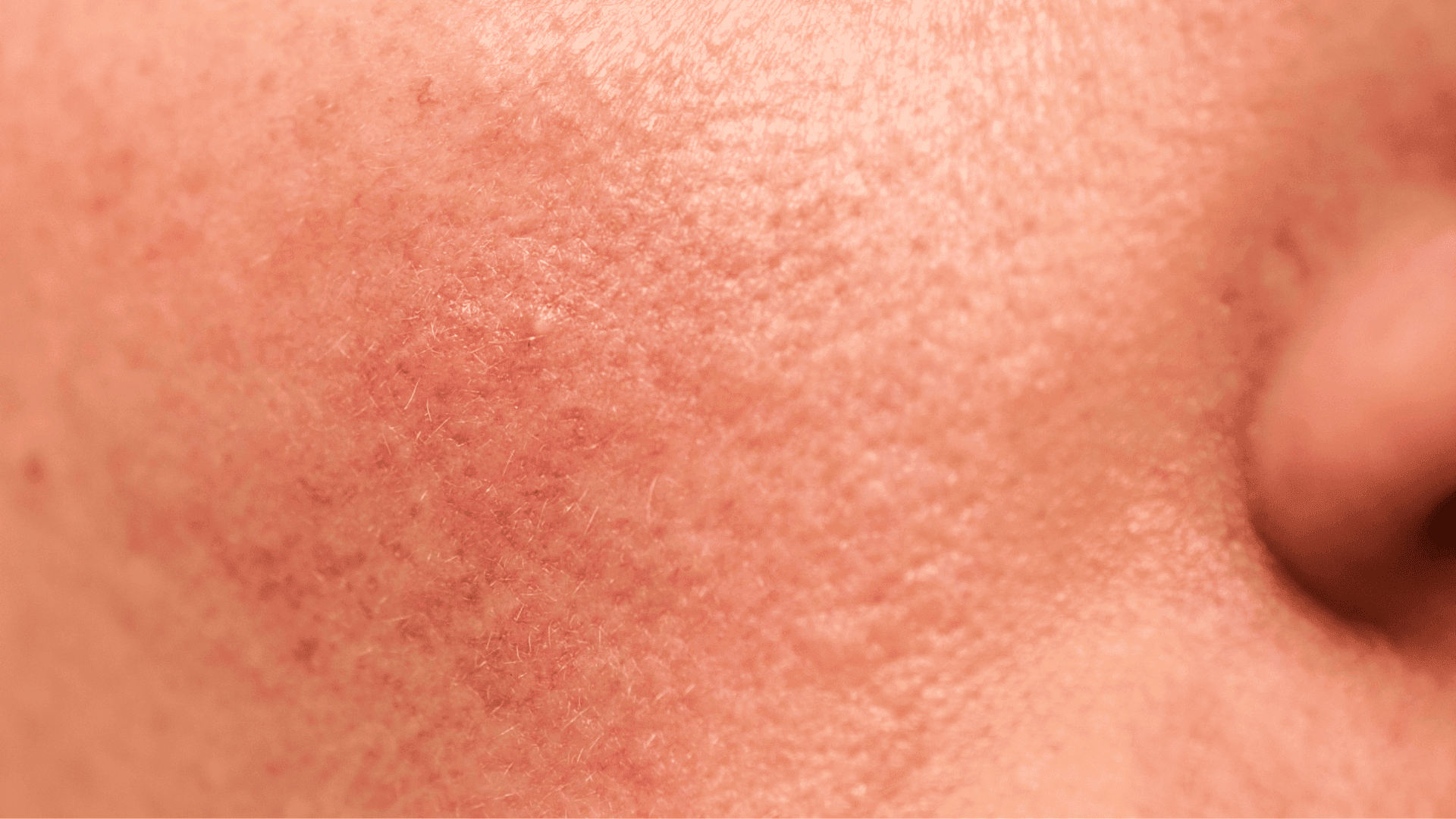 How to Tell If Your Skin Barrier Is Damaged (And What to Do About It) - GRAES