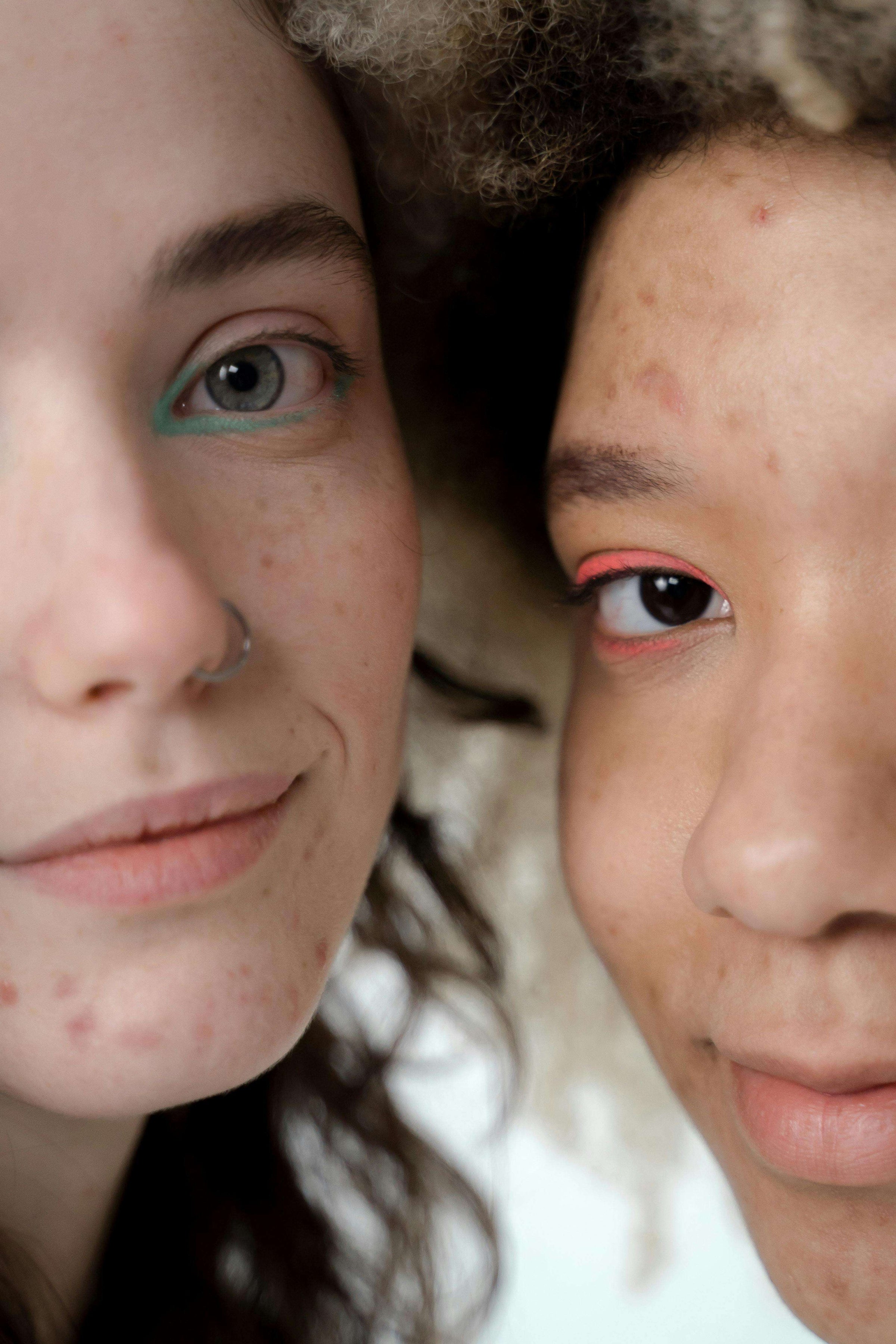 How to Treat Post Inflammatory Hyperpigmentation Without Irritating Skin - GRAES
