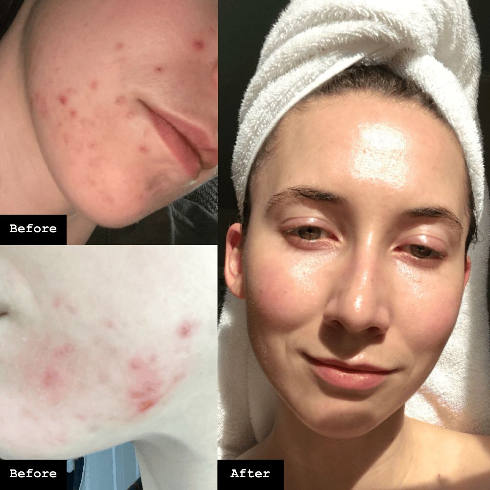 Before and after comparison of a person's face with acne vs without.
